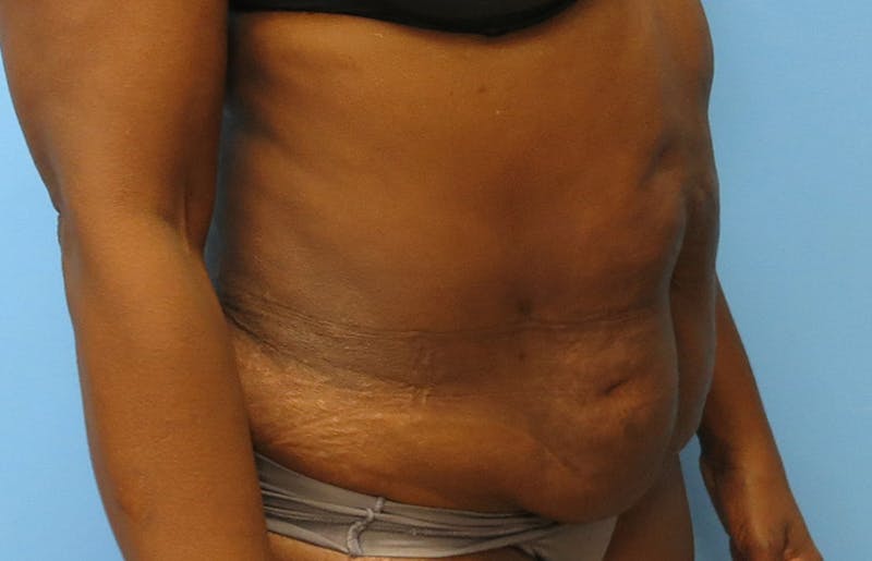 Abdominoplasty Before & After Gallery - Patient 112338733 - Image 7