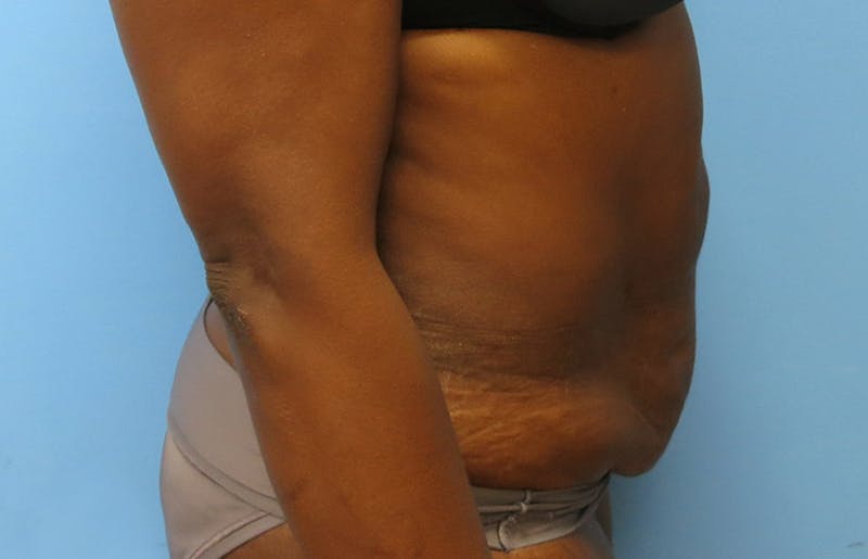 Abdominoplasty Before & After Gallery - Patient 112338733 - Image 9