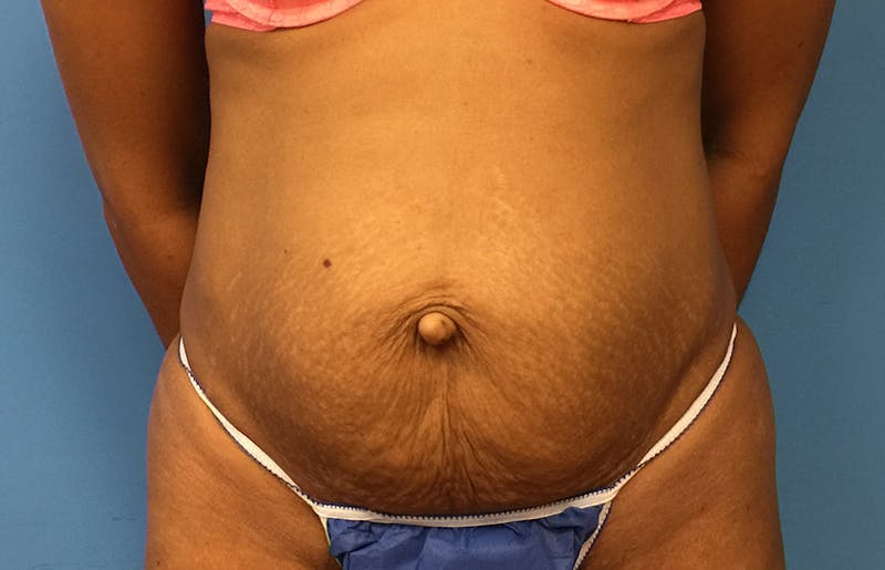 Abdominoplasty Before & After Gallery - Patient 112338737 - Image 5