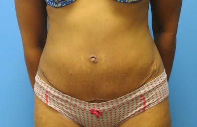 Abdominoplasty Before & After Gallery - Patient 112338737 - Image 6