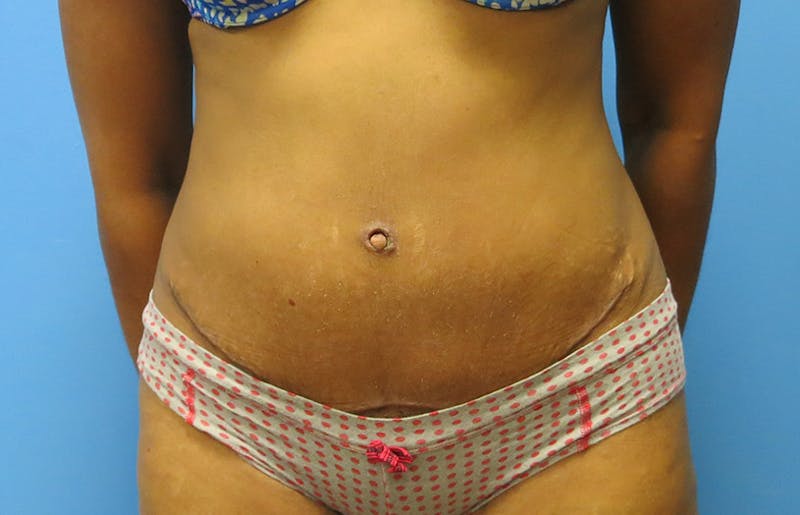Abdominoplasty Before & After Gallery - Patient 112338737 - Image 6