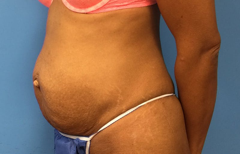 Abdominoplasty Before & After Gallery - Patient 112338737 - Image 3