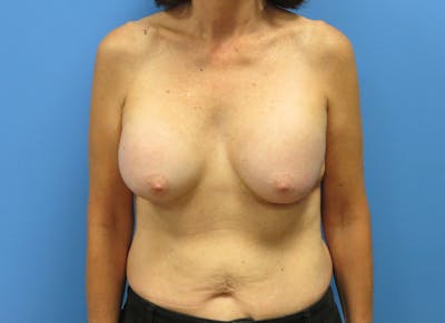 Augmentation Before & After Gallery - Patient 112340397 - Image 5