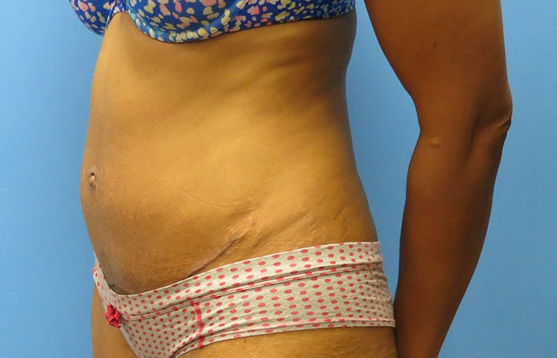 Abdominoplasty Before & After Gallery - Patient 112338737 - Image 4