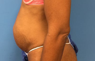 Abdominoplasty Before & After Gallery - Patient 112338737 - Image 1