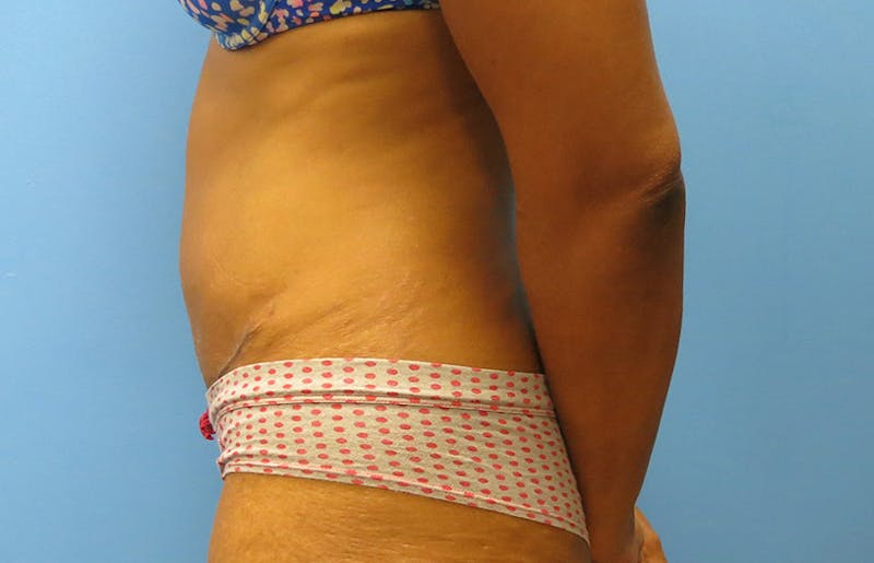 Abdominoplasty Before & After Gallery - Patient 112338737 - Image 2