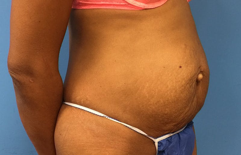 Abdominoplasty Before & After Gallery - Patient 112338737 - Image 7