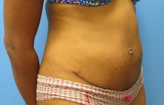 Abdominoplasty Before & After Gallery - Patient 112338737 - Image 8