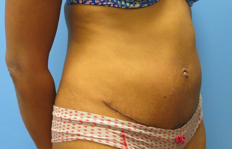 Abdominoplasty Before & After Gallery - Patient 112338737 - Image 8