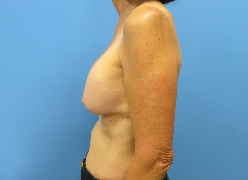 Augmentation Before & After Gallery - Patient 112340397 - Image 1