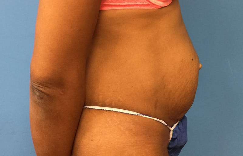 Abdominoplasty Before & After Gallery - Patient 112338737 - Image 9