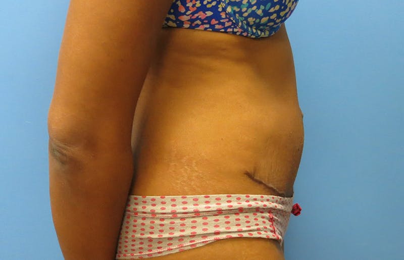 Abdominoplasty Before & After Gallery - Patient 112338737 - Image 10