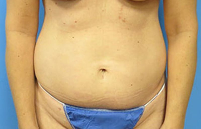 Abdominoplasty Before & After Gallery - Patient 112340400 - Image 5