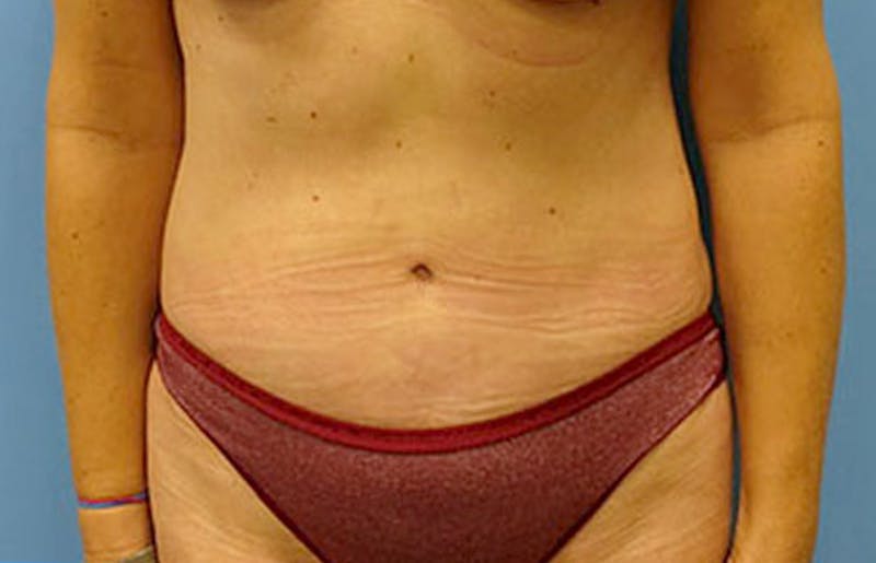 Abdominoplasty Before & After Gallery - Patient 112340400 - Image 6