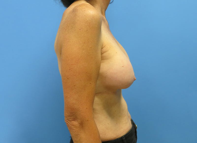 Augmentation Before & After Gallery - Patient 112340397 - Image 9