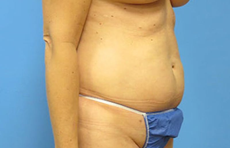 Abdominoplasty Before & After Gallery - Patient 112340400 - Image 7