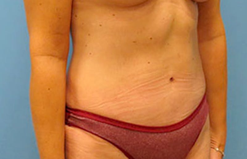 Abdominoplasty Before & After Gallery - Patient 112340400 - Image 8