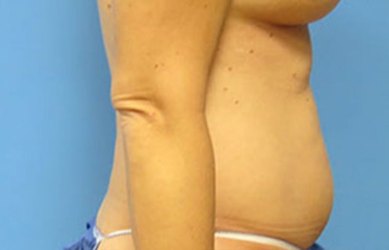 Abdominoplasty Before & After Gallery - Patient 112340400 - Image 9