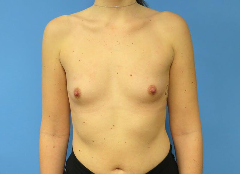 Augmentation Before & After Gallery - Patient 112340402 - Image 5
