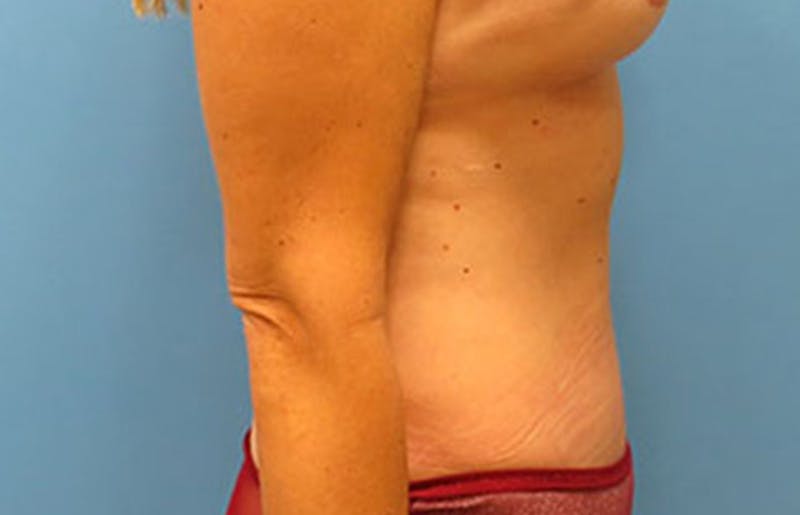 Abdominoplasty Before & After Gallery - Patient 112340400 - Image 10