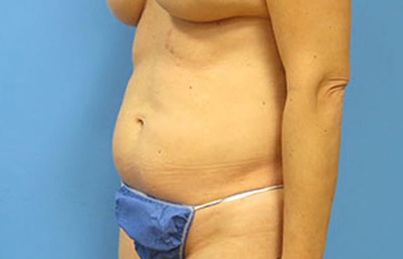 Abdominoplasty Before & After Gallery - Patient 112340400 - Image 3