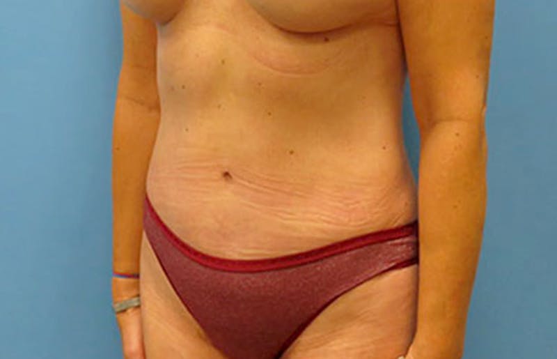 Abdominoplasty Before & After Gallery - Patient 112340400 - Image 4
