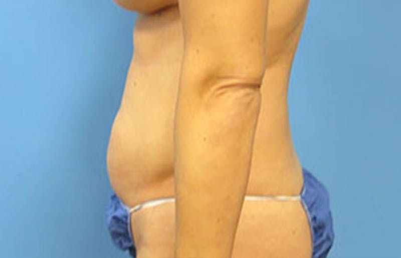 Abdominoplasty Before & After Gallery - Patient 112340400 - Image 1