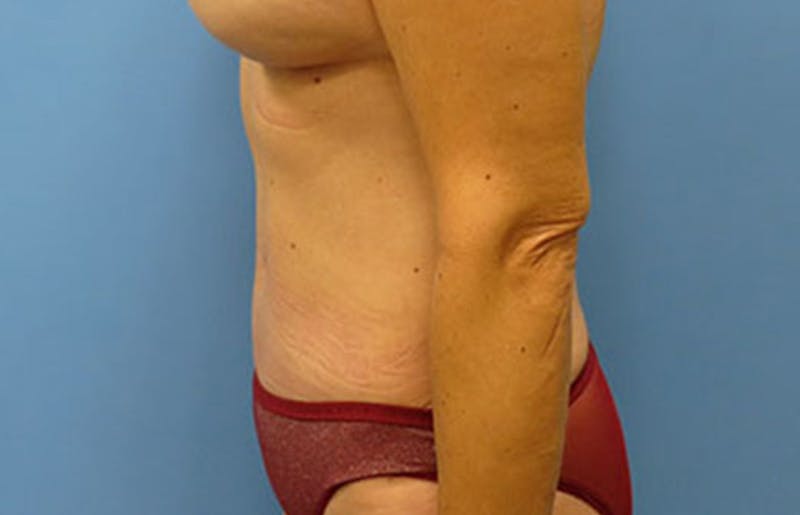 Abdominoplasty Before & After Gallery - Patient 112340400 - Image 2