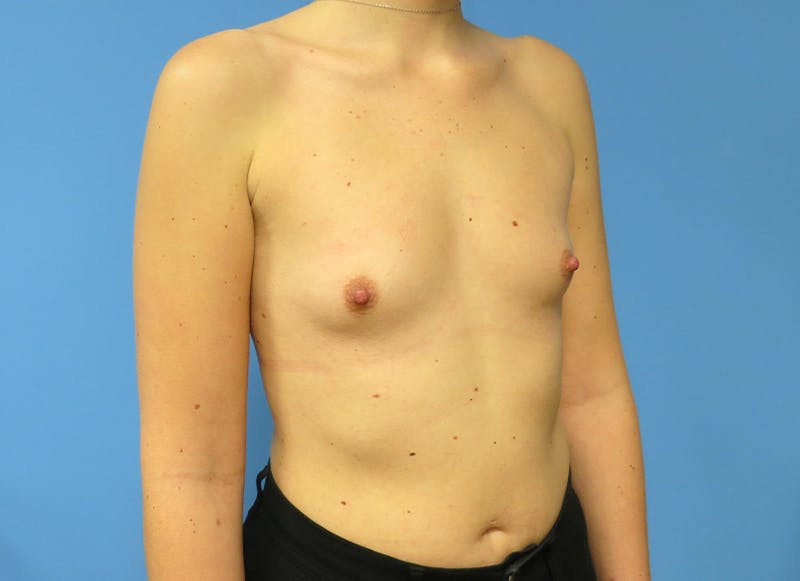 Augmentation Before & After Gallery - Patient 112340402 - Image 7