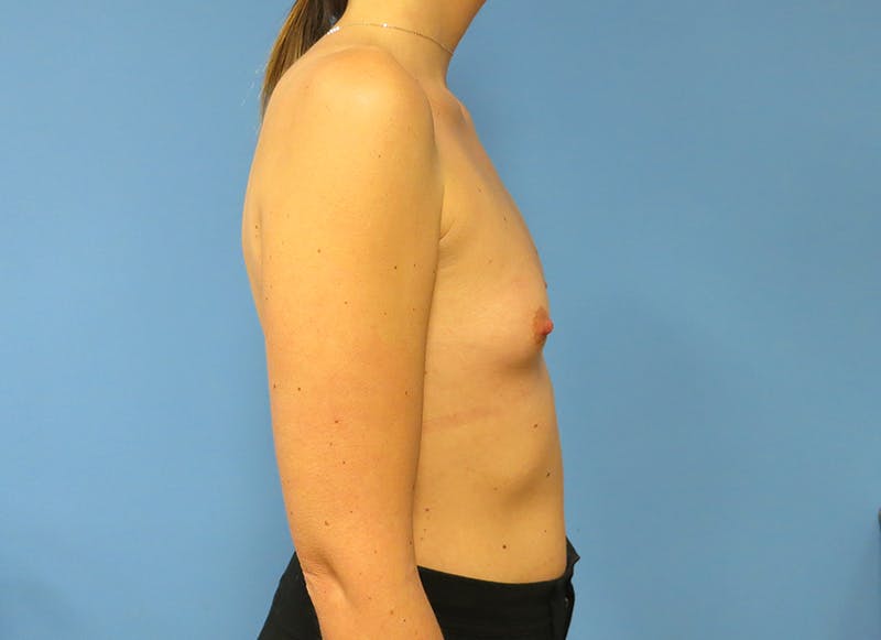 Augmentation Before & After Gallery - Patient 112340402 - Image 9