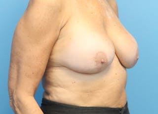 Augmentation Before & After Gallery - Patient 112341441 - Image 8