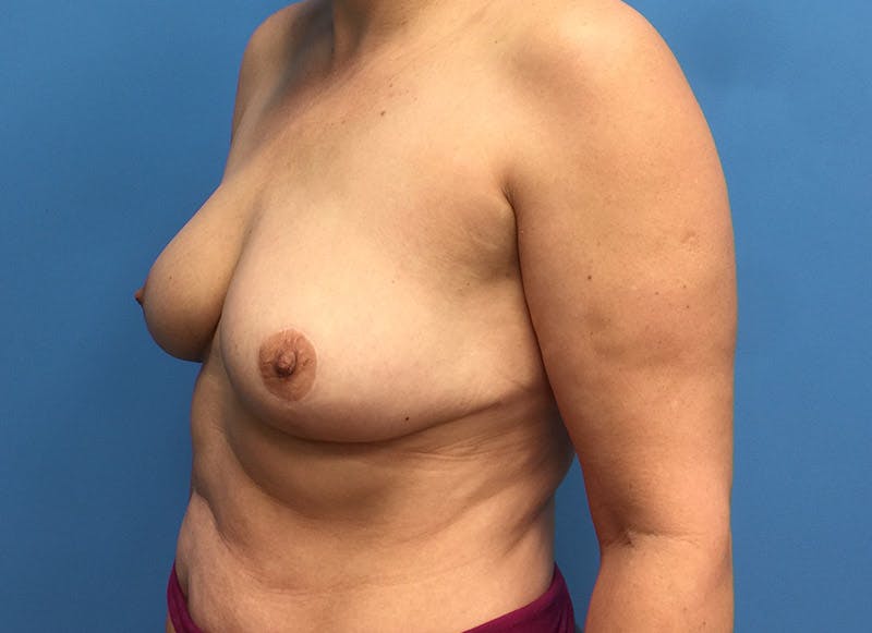 Breast Reduction Before & After Gallery - Patient 112341454 - Image 3