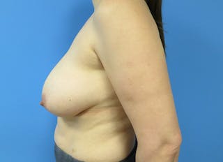 Breast Reduction Before & After Gallery - Patient 112341454 - Image 2