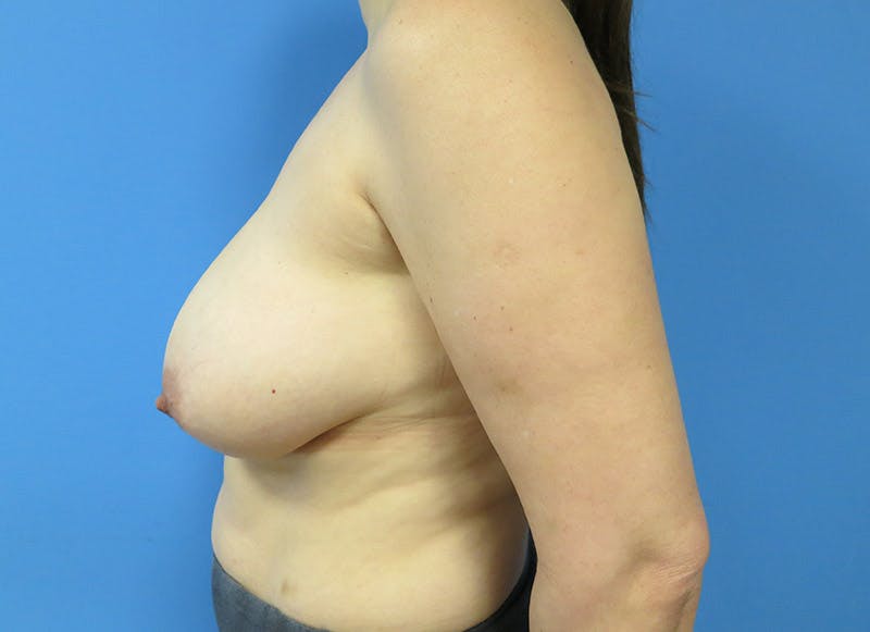 Breast Reduction Before & After Gallery - Patient 112341454 - Image 2
