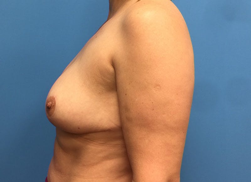 Breast Reduction Before & After Gallery - Patient 112341454 - Image 1