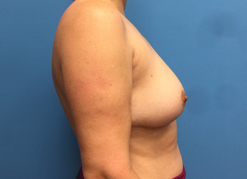 Breast Reduction Before & After Gallery - Patient 112341454 - Image 10