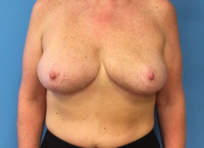 Breast Reduction Before & After Gallery - Patient 112341455 - Image 6