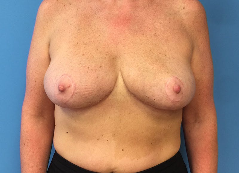 Breast Reduction Before & After Gallery - Patient 112341455 - Image 6