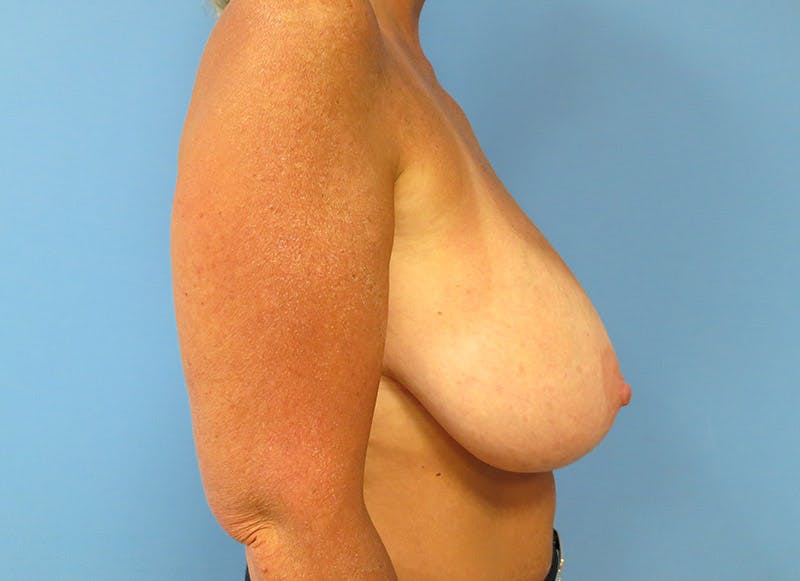 Breast Reduction Before & After Gallery - Patient 112341455 - Image 9