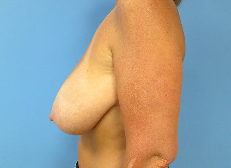 Breast Reduction Before & After Gallery - Patient 112341455 - Image 1