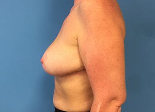 Breast Reduction Before & After Gallery - Patient 112341455 - Image 2