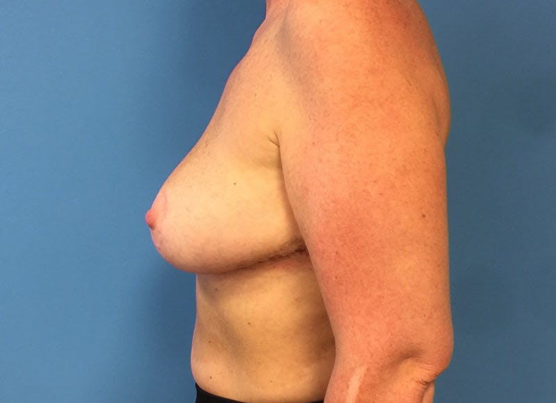 Breast Reduction Before & After Gallery - Patient 112341455 - Image 2