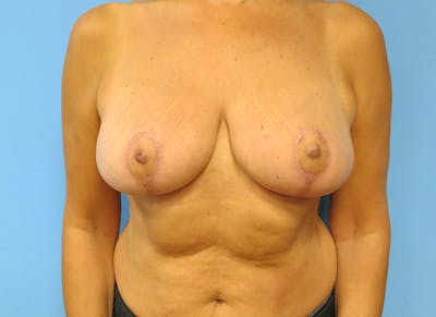 Breast Reduction Before & After Gallery - Patient 112341457 - Image 6