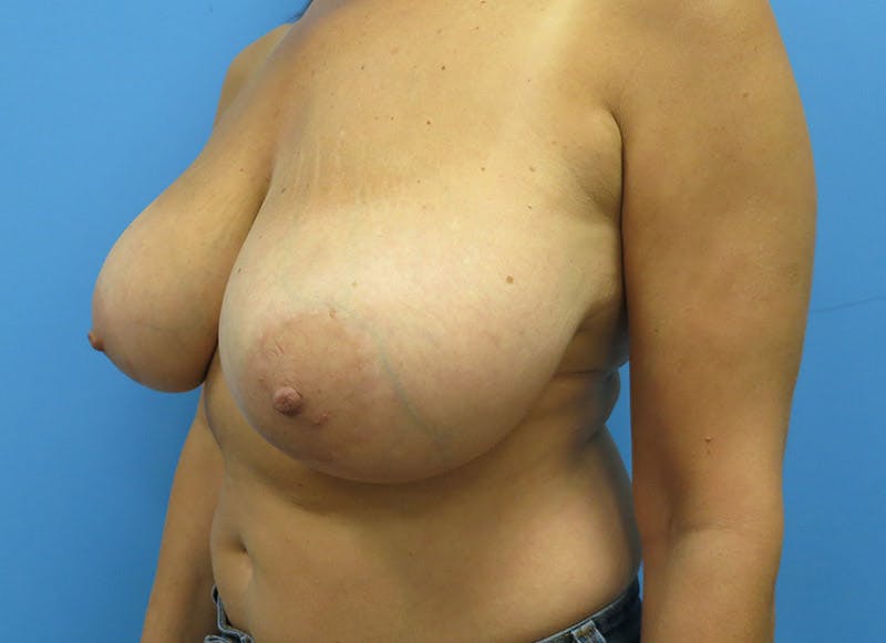 Breast Reduction Before & After Gallery - Patient 112341457 - Image 3