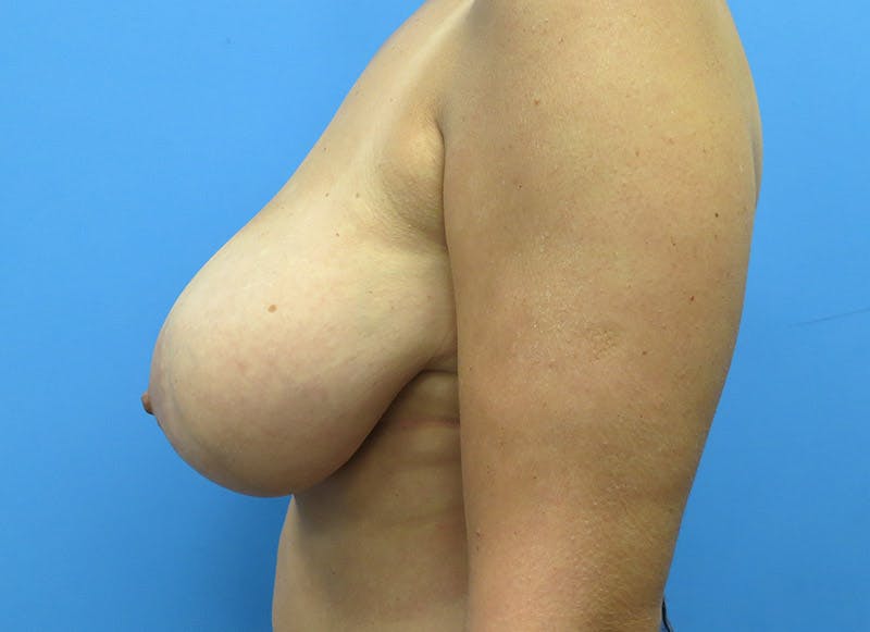 Breast Reduction Before & After Gallery - Patient 112341457 - Image 1