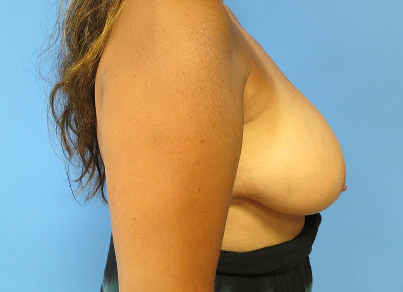 Breast Reduction Before & After Gallery - Patient 112341485 - Image 9