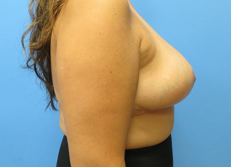 Breast Reduction Before & After Gallery - Patient 112341485 - Image 10