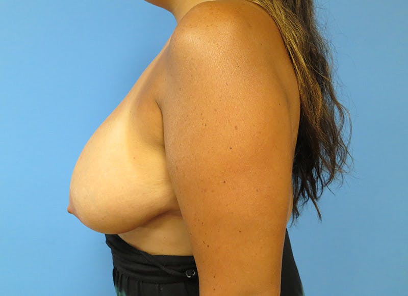 Breast Reduction Before & After Gallery - Patient 112341485 - Image 1