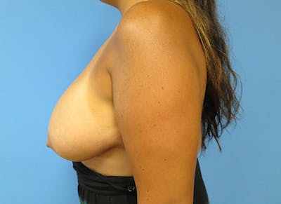 Breast Reduction Before & After Gallery - Patient 112341485 - Image 1