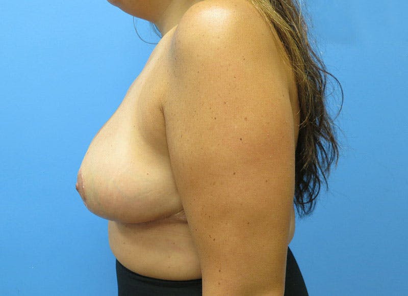 Breast Reduction Before & After Gallery - Patient 112341485 - Image 2